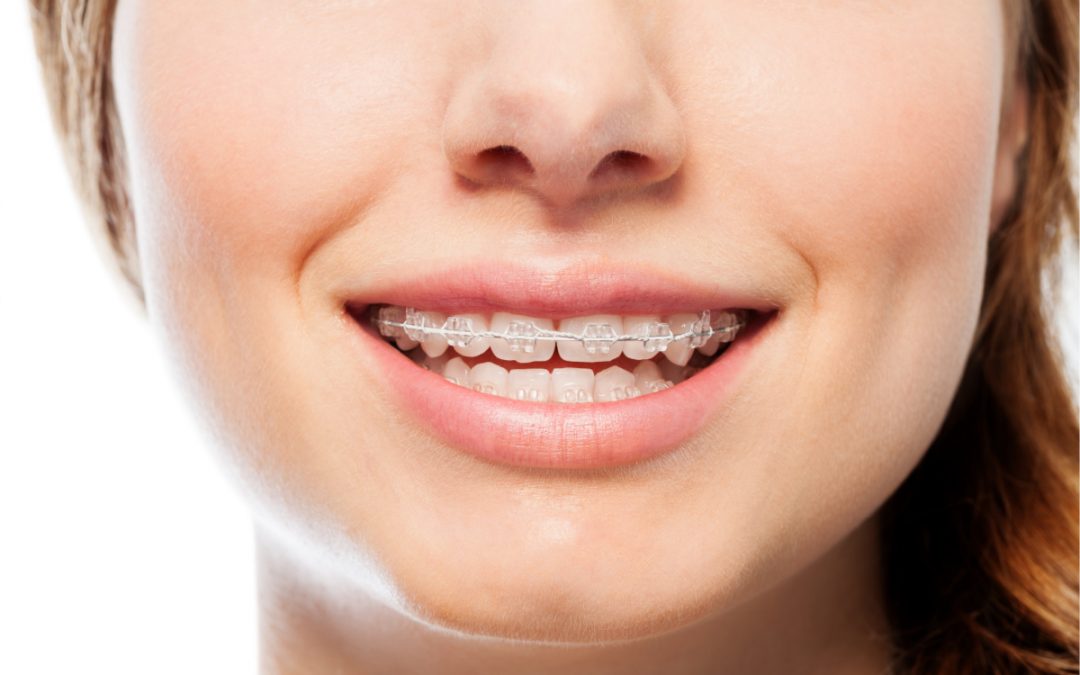 Clear Braces: Everything You Need to Know